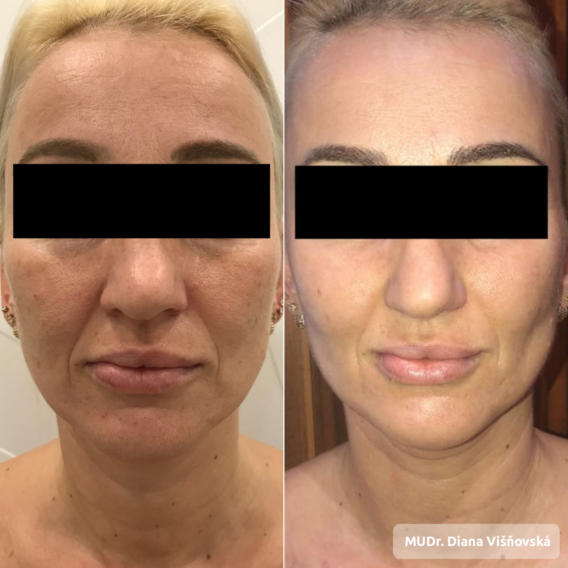 FRACTIONAL CO2 LASER-SKIN-RESURFACING | Concept Clinic